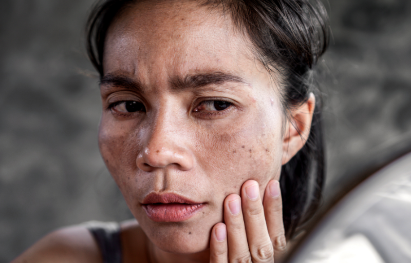 femme avec des tâches cutanées