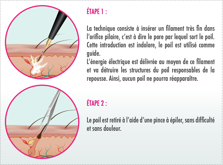 étapes épilation électrolyse
