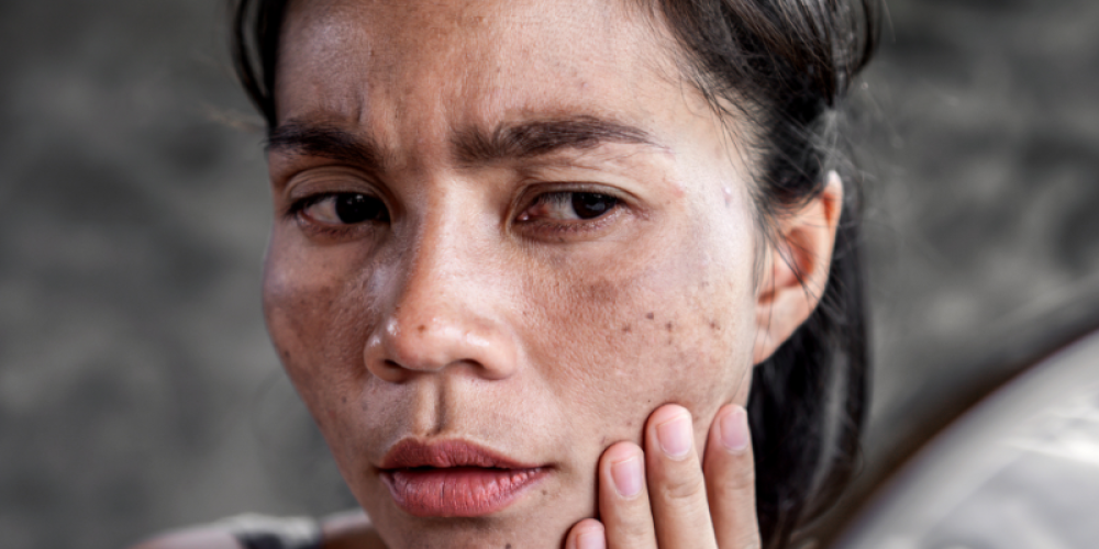 femme avec des tâches cutanées